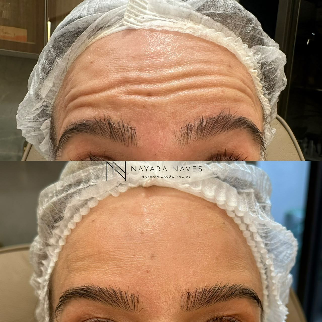 Resultado frontal de tratamento realizado pela Dra. Nayara Naves