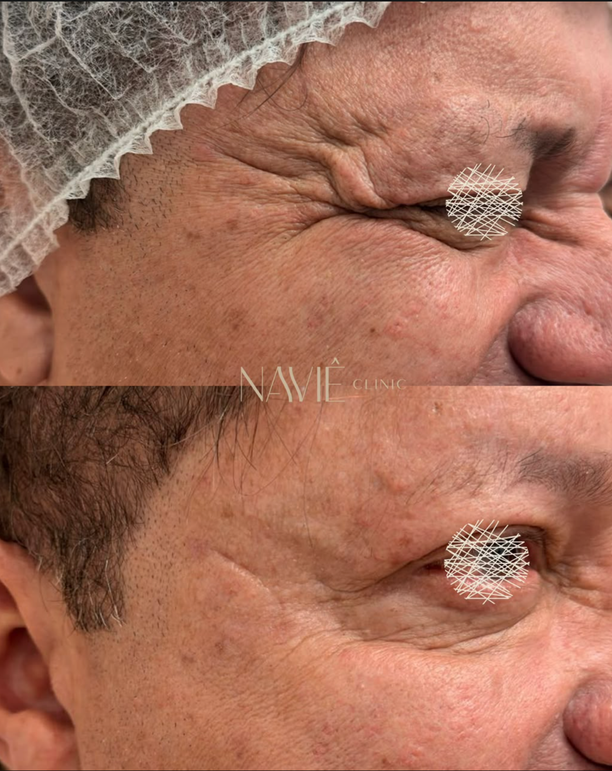 Resultado masculino de tratamento realizado pela Dra. Nayara Naves